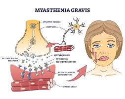 MG is caused by a breakdown in communication between nerves and muscles, due to the immune system attacking the receptors that help muscles contract